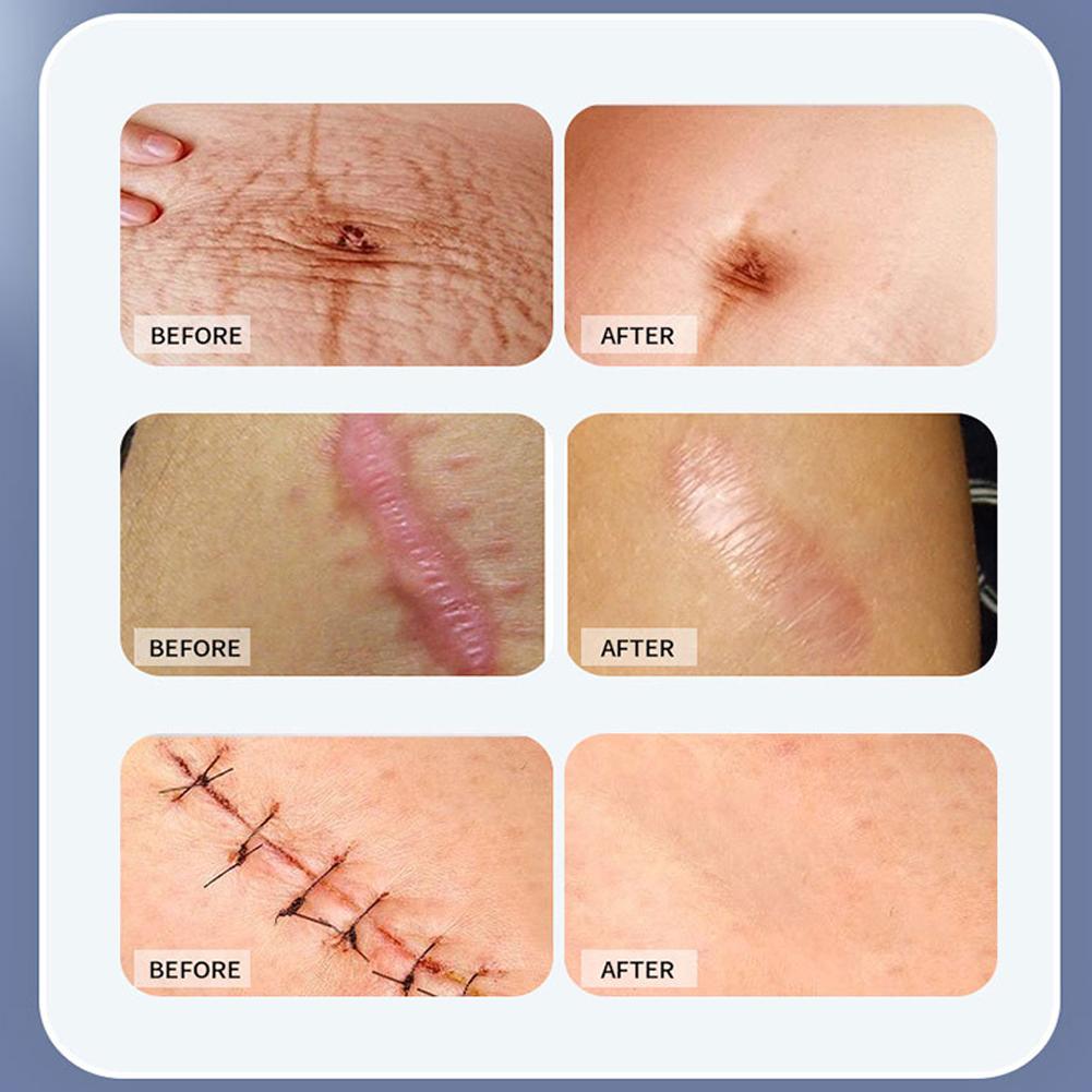 Силиконовая лента для рубцов от хирургических рубцов, медицинская эффективная силиконовая безболезненная лента для рубцов Z1Q2