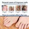 Toenail Correction Patch,  Ingrown Toenails Treatment Sticker - Toe Correction Sticker