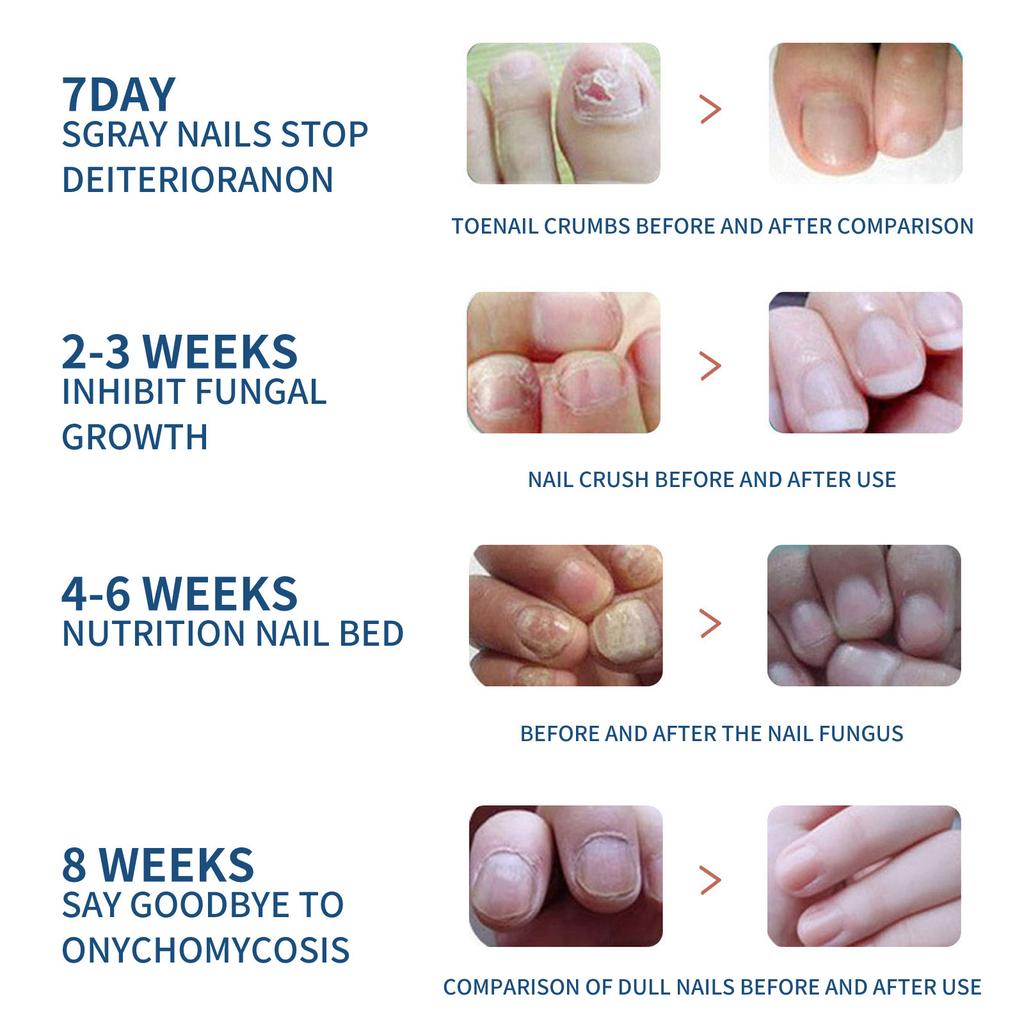 32PCS Foot Nail Repair Patch Grey Fungal Nail Thicken Soft Paronychia Infection Hand Nail Correction Sticker Ingrown Toenail