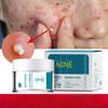 Acne Removing Cream Regulates Acne Muscles, Removes Acne, Desalinates Acne Marks, Moisturizes and Repairs Face Cream Acne Removing Cream