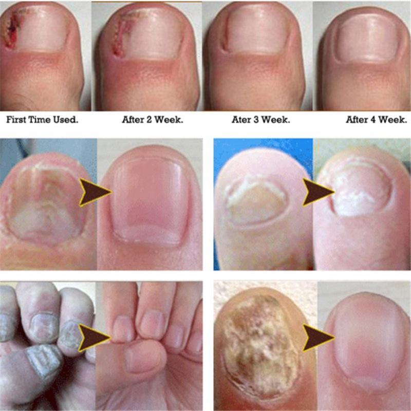 Anti Fungus Nail Onychomycosis Nail Repair Treatment Liquid Cleanser Herbal Disinfection Serum