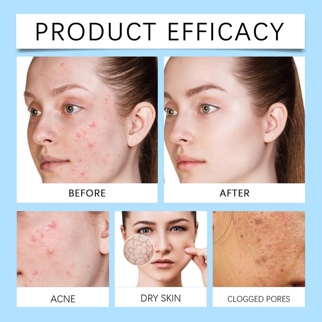 12% Азелаиновая сыворотка Азелаиновый крем помогает при покраснениях, отеках и прыщах на чувствительной коже, 30 г(1шт