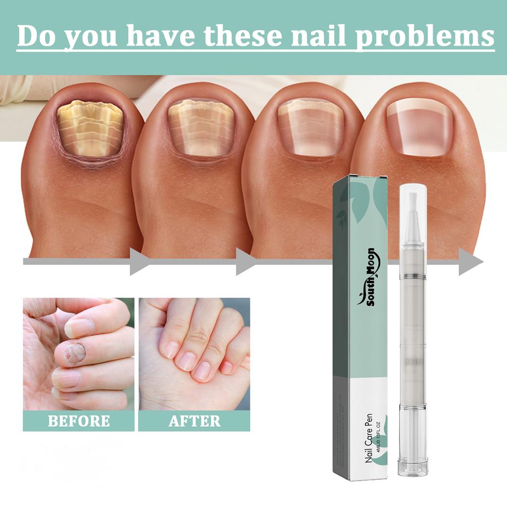 South Moon Onychomycosis Care Очищающий, осветляющий и утолщающий карандаш для онихомикоза