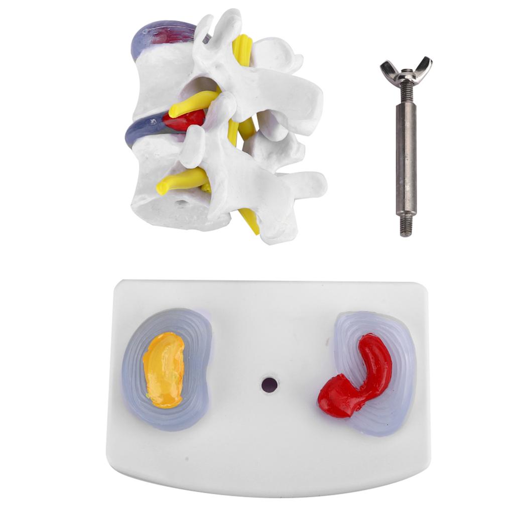 Анатомическая демонстрационная модель поясничной грыжи позвоночника человека, школьные учебные принадлежности
