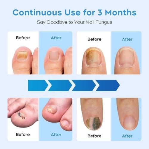 Portable Nail Fungus Treatment Device - Rechargeable LED Light Therapy for Thickened and Discolored Nails. Effective Nail Care for Fingernails and Toe