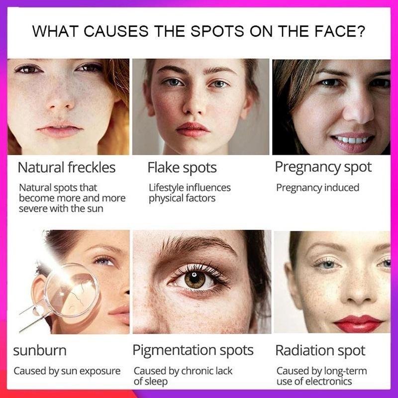 Новейший крем-корректор темных пятен, отбеливающий крем для лица, ремонт, выцветание веснушек, удаление темных пятен, средство для удаления меланина, осветляющий крем для лица