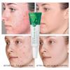 LAIKOU Aloe Acne Removal Gel, крем для лечения акне, крем для лечения рубцов от угревой сыпи, уход за лицом, отбеливание, увлажнение