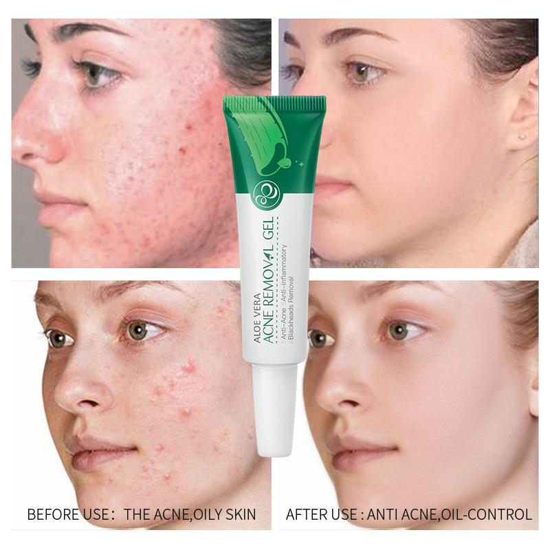 LAIKOU Aloe Acne Removal Gel, крем для лечения акне, крем для лечения рубцов от угревой сыпи, уход за лицом, отбеливание, увлажнение