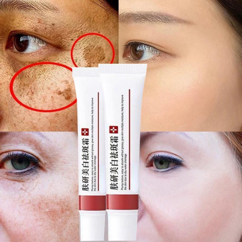 Whitening Freckle Cream Effective Remove Dark Spots Anti Freckle Cream Fade Pigmentation Melasma Brighten Cream