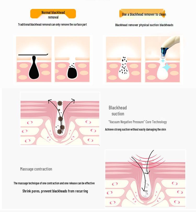 Горячая Распродажа Набор для Удаления Черных Точек и Очищения Пор