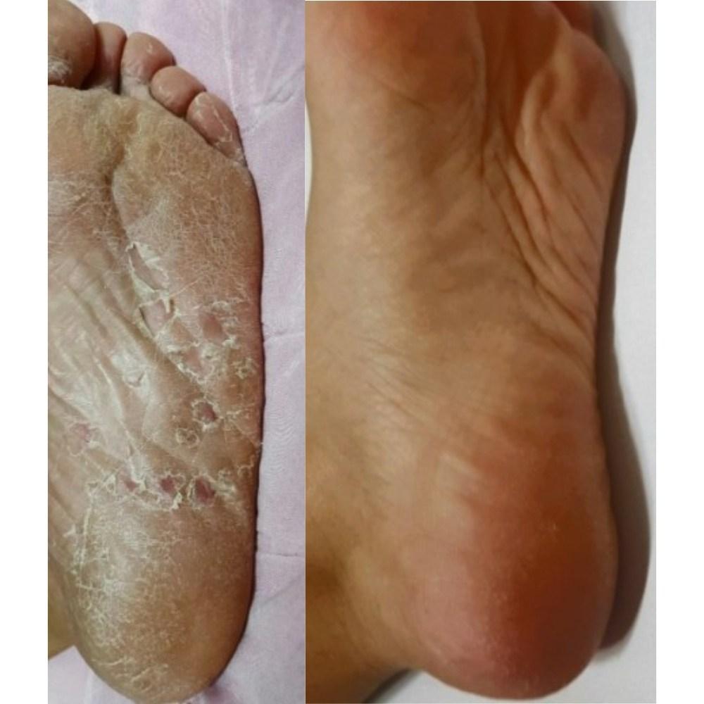 Perorin Don Quijote набор для удаления мозолей на ногах с ароматом розы, 2 упаковки, 1 упаковка