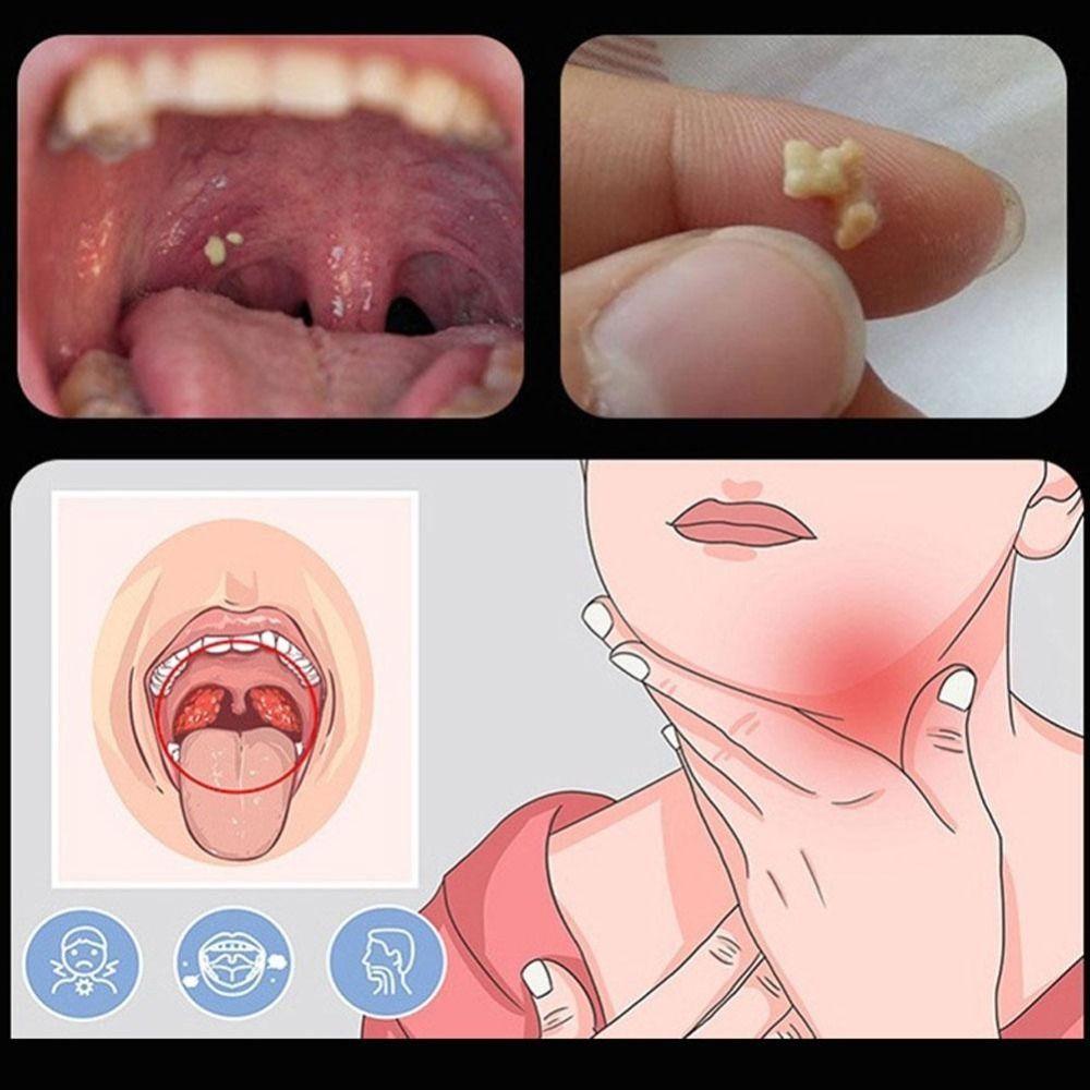 Очиститель полости рта для удаления камней, набор для удаления камней из нержавеющей стали