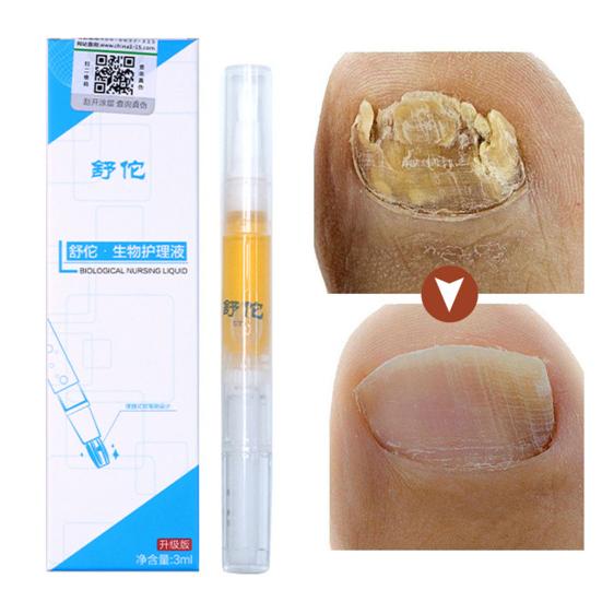 4 шт. жидкость для лечения грибка ногтей универсальная противогрибковая легкая полезная ручка для питания и ремонта дома