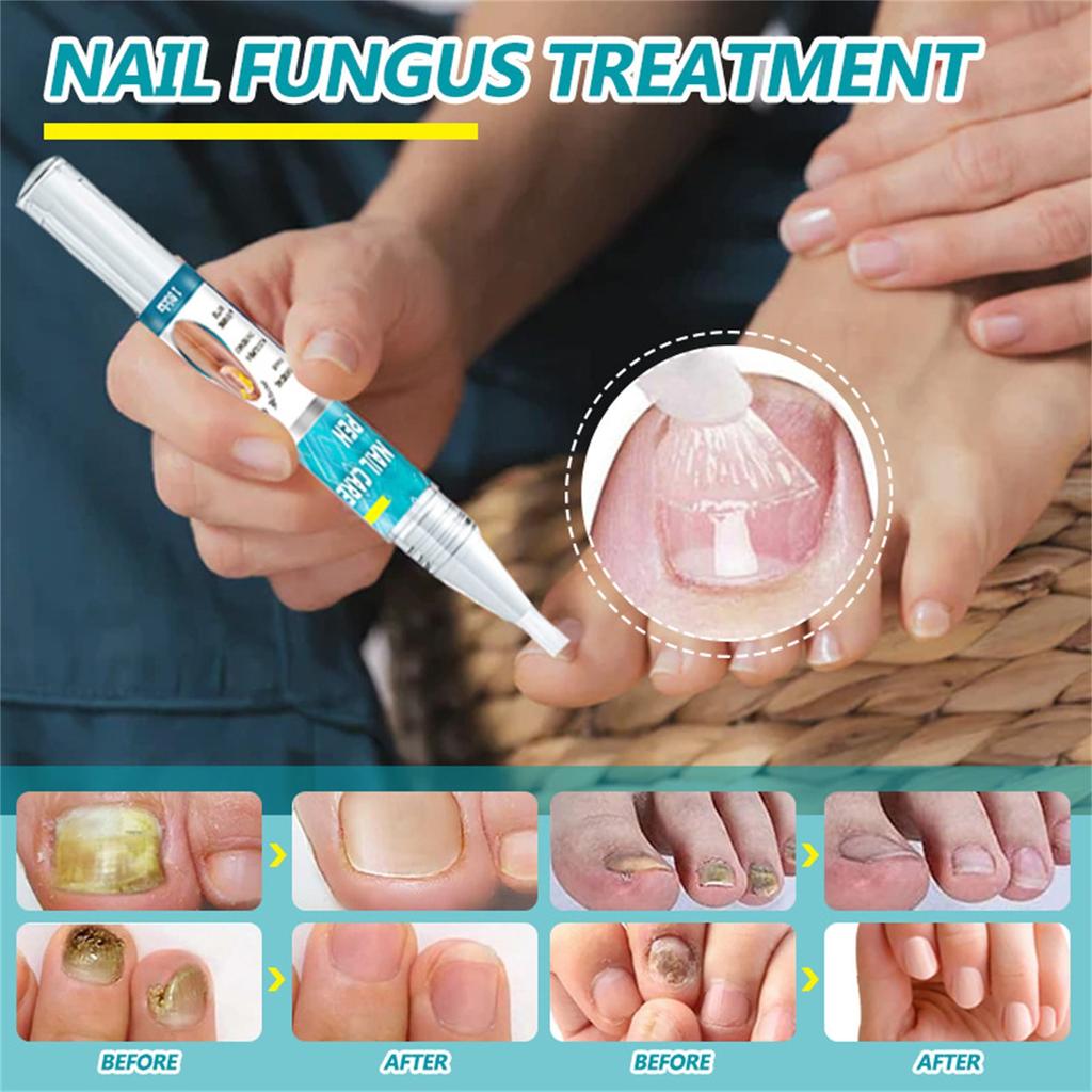 Уход за ногтями с грибком, быстродействующая жидкость для ухода за ногтями от грибка под ногтями и вокруг них, восстанавливает здоровый вид ногтей 5 мл