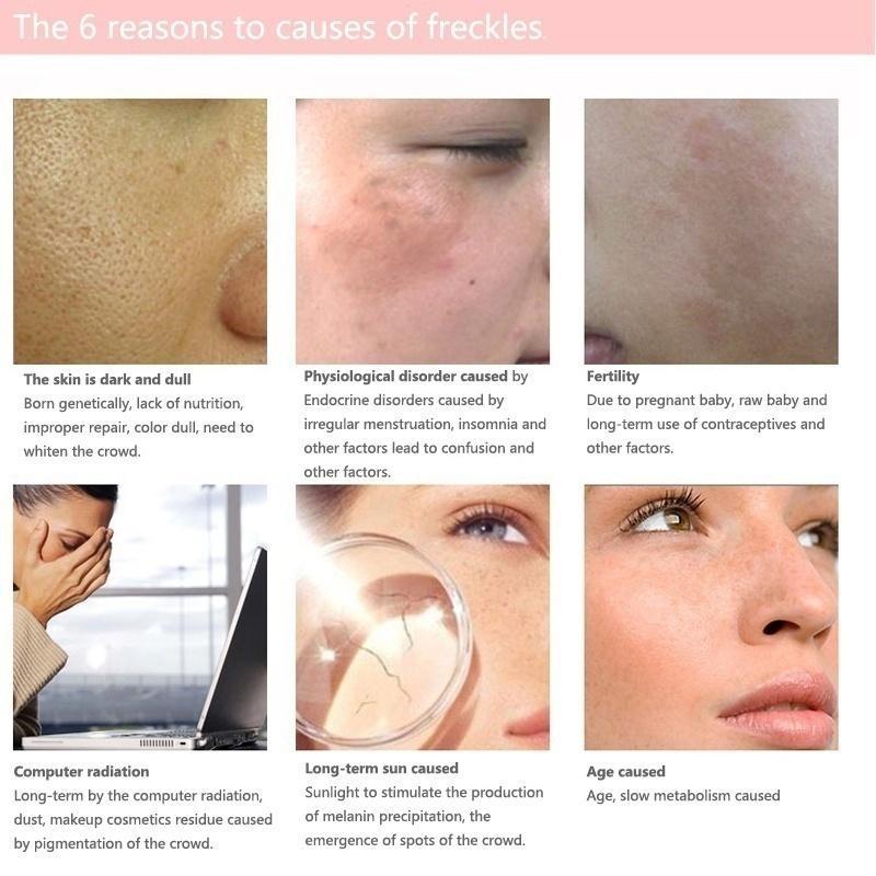 Новейший крем от веснушек с конским маслом, выцветание, пятна, солнечные ожоги, хлоазма, веснушки, уход за лицом