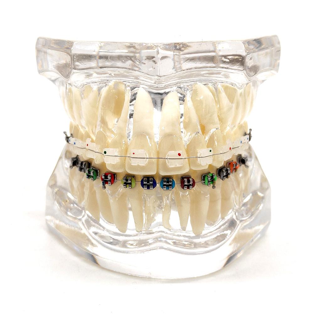 1 шт., стоматологическая ортодонтическая модель, связь с пациентом, 2 вида брекетов с дугами, лигатуры, керамический брекет, металлический краевой брекет