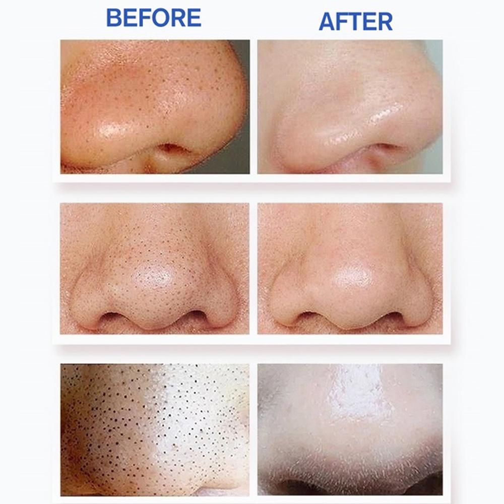 Всасывающий очиститель пор для лица, вакуумный электрический экстрактор для удаления черных точек, 4 в 1