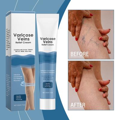 Крем для облегчения варикозного расширения вен Уход за массажем ног Массаж, Синие вены и красные кровеносные сосуды Варикозное расширение вен, Усталость и болезненность ног, Уменьшить отек А