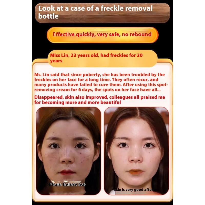 Whitening and Freckle Removing Cream Face Cream Lightening and Removing Spotles Sunburn Brightening Skin Color