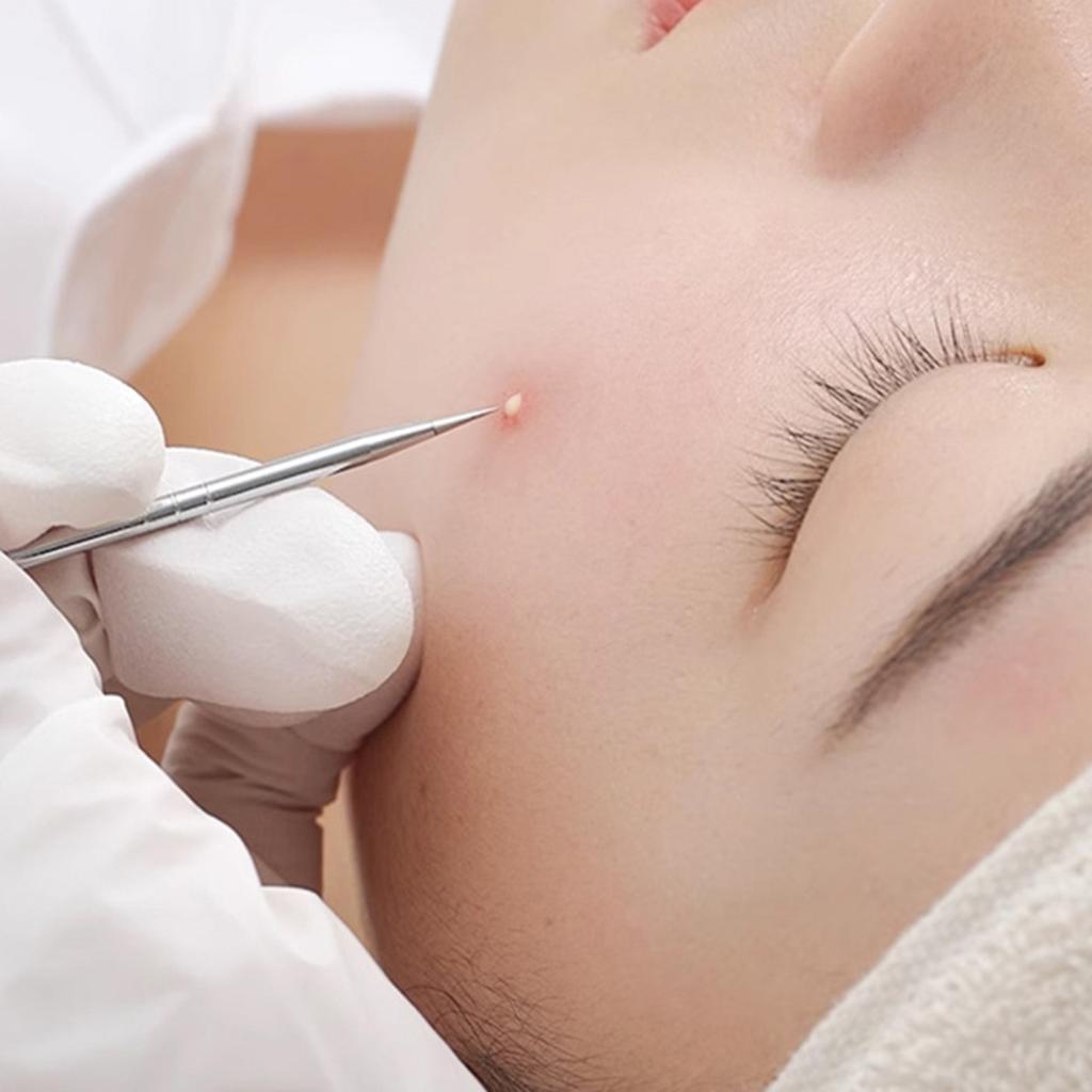 Набор инструментов для удаления черных точек Профессиональный экстрактор черных точек с футляром и 5-кратным увеличительным стеклом для удаления прыщей, черных точек, прыщей, лба, лица, носа