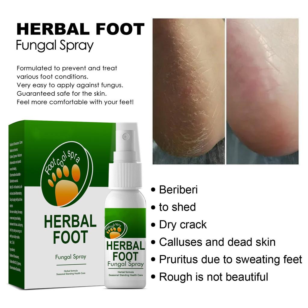 30 мл травяной спрей для ног, пот ног, запах ног, спрей, снимающий зуд, спрей для ухода за ногами от запаха пилинга