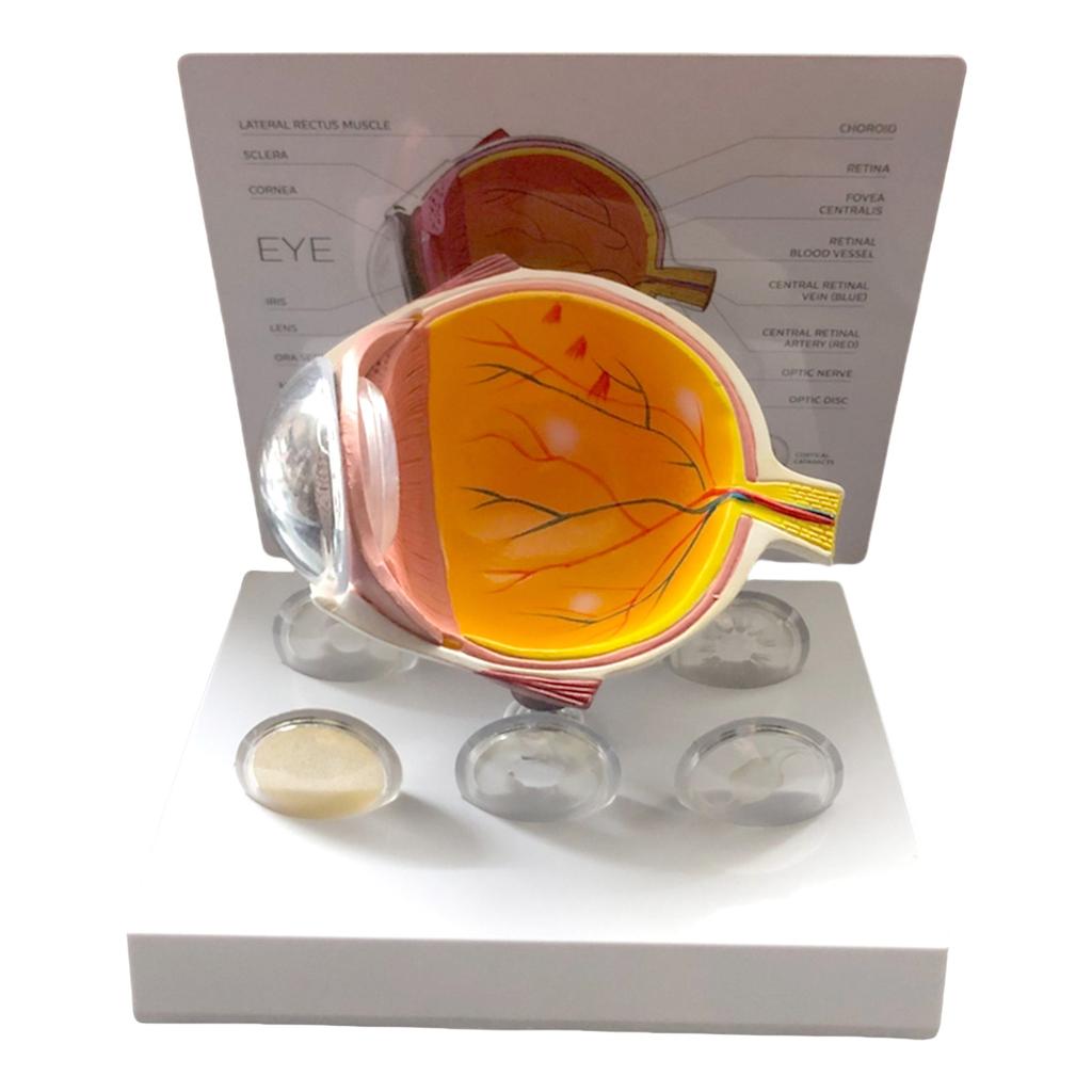 Модель анатомии человеческого глаза Анатомическая патологическая модель глазного яблока Обучающее пособие Реалистичная патологическая модель анатомии глазного яблока