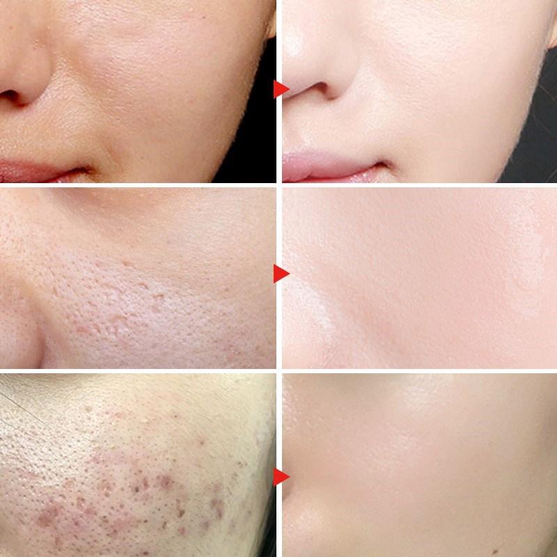 Крем-сыворотка для лица с травами и витамином С, комбинированный, для удаления акне и следов от прыщей, увлажняющий, осветляющий, набор для ухода за кожей лица JoyPretty