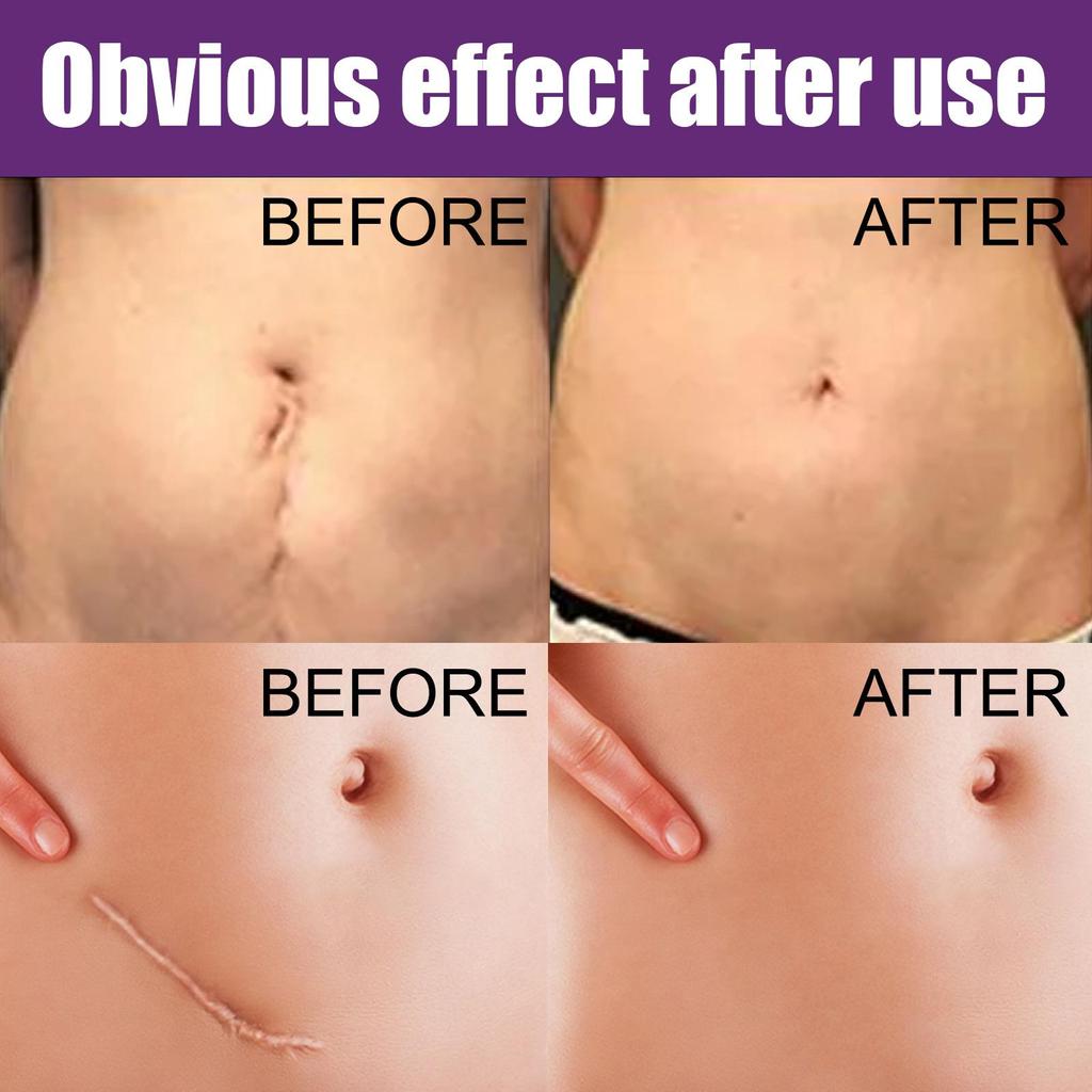 Silicone Scar Tape Scar Sheets for Removing Scars Adaptable Easy-Tear Scar Tape Reusable for C-Section