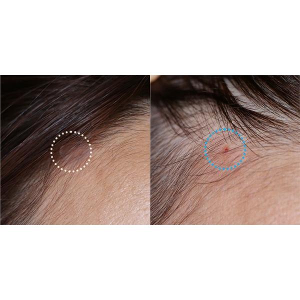 HATHERINE Spot Care Patch Kit (2 Types Spot Patch Duo) 76 Patches