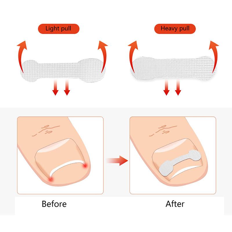 Корректор пасты для ногтей, патч для ногтей, зажим для ногтей, рукав для педикюра, быстрая наклейка