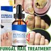 Repair Nail Fungus Treatments Essence Foot Care Serum Toe Nails Fungal Removal Gel Anti-Infection