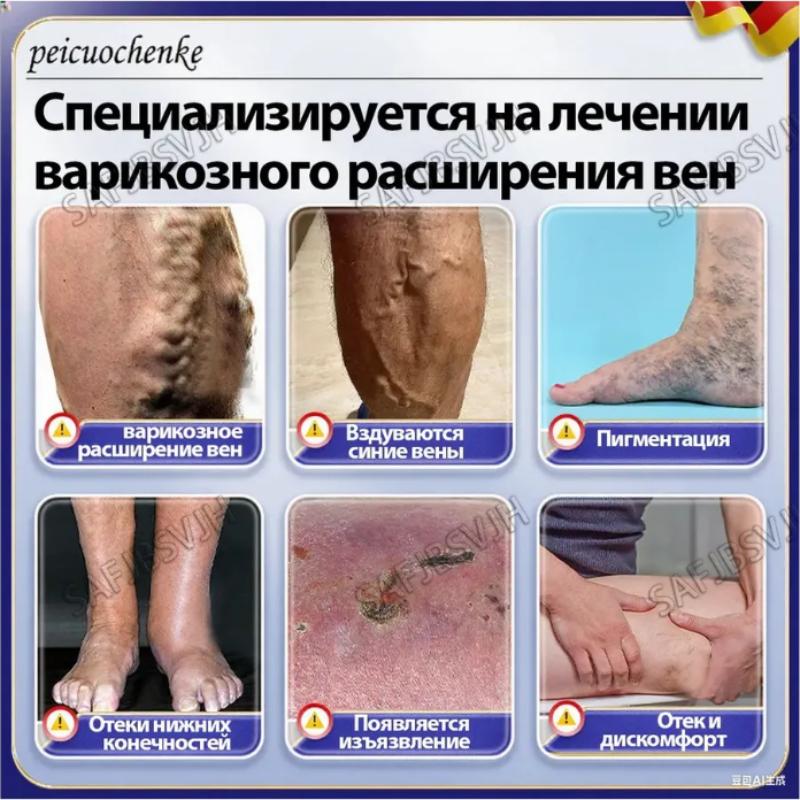 Профессиональная мазь от варикозного расширения вен