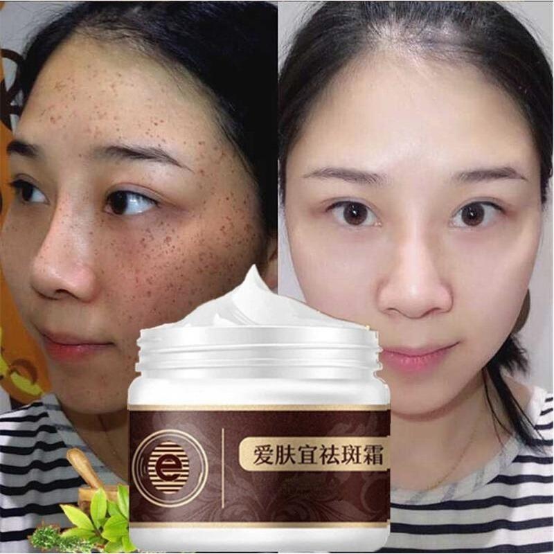 100% ORIGINAL Freckle Cream Anti-dark Spots and Brightening Skin Whitening Cream