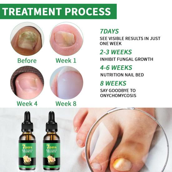 30ml Nail Growth Serum Ginger Nail Treatment Nail Growth Repair Essential Oils