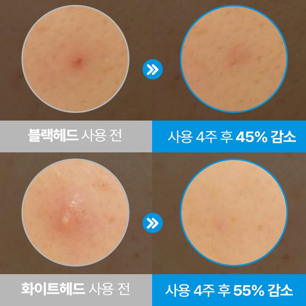 Hiruscar Post Acne Clear Essence, 10g