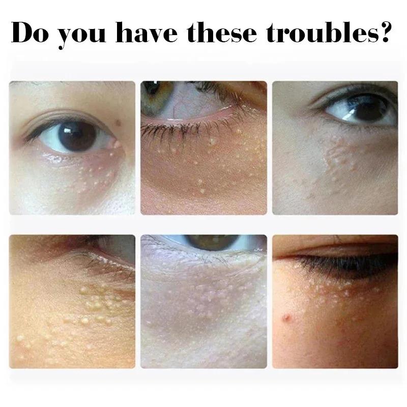 Крем для глаз для удаления жировиков, разглаживающий мелкие морщины, уменьшающий темные круги, восстанавливающий барьер, против отечности, противовоспалительный крем