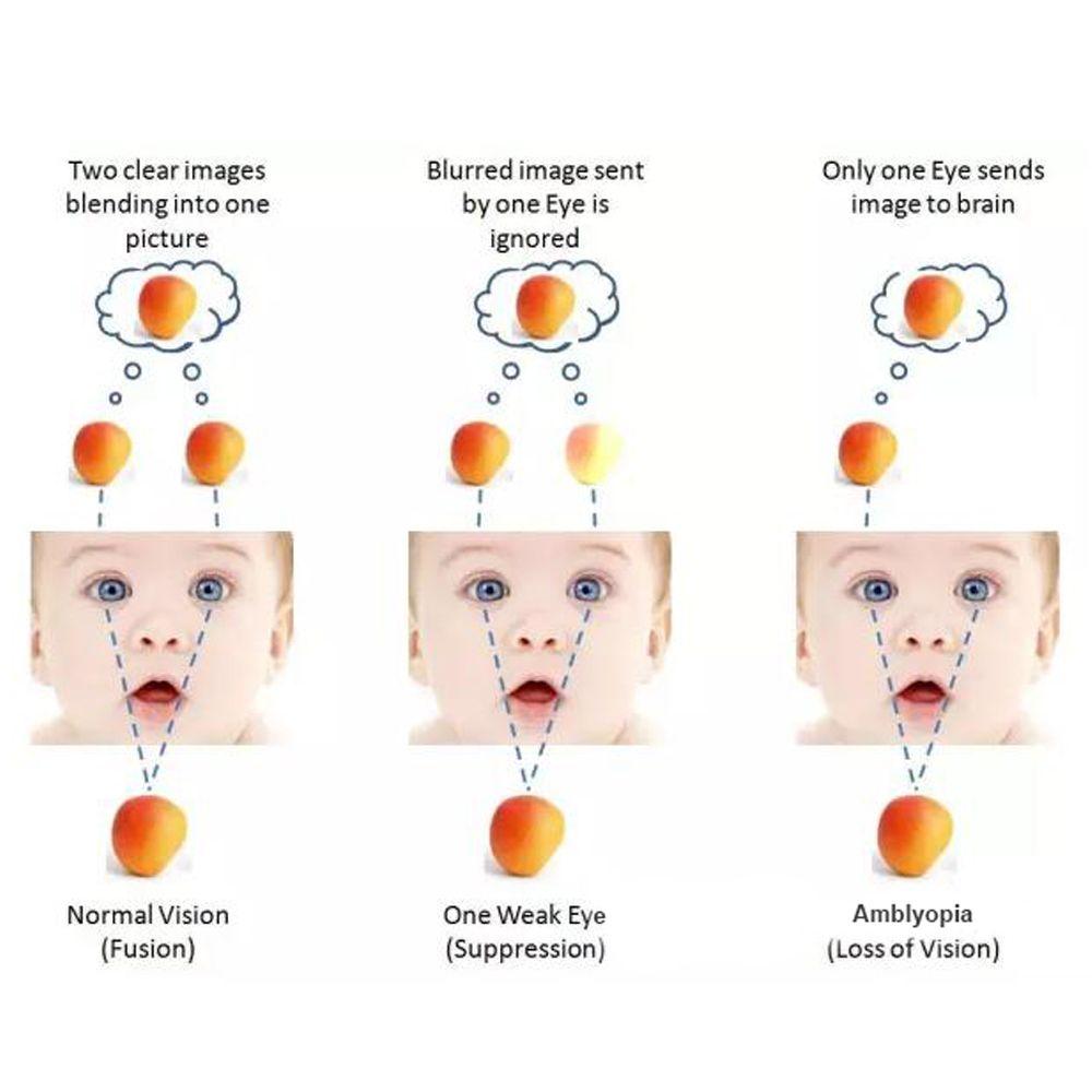 New Sight Orthoptic Disposable Medical use Child Amblyopia Training Eye Cover Eye Patches Eyeshade