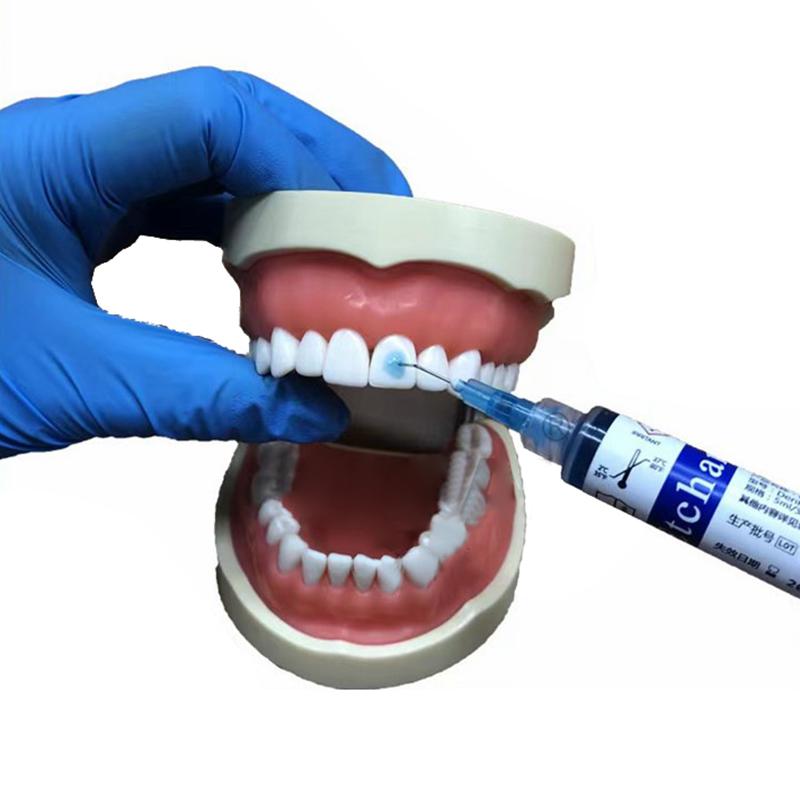 Стоматологический материал Протравка 37% Фосфорная кислота Протравка Травящий гель с 5 наконечниками для ортодонтического адгезива Светоотверждаемый Бонд Зубной клей