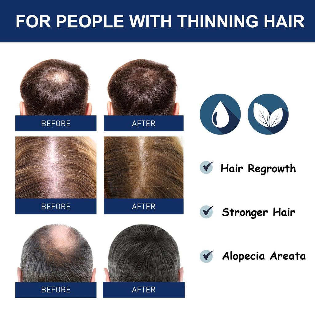 Крем Средства против выпадения волос Быстрорастущие Предотвращают сухость Пушистость Поврежденные Лечебное средство Уход за кожей головы Борода Мужчины Женщины 20 г