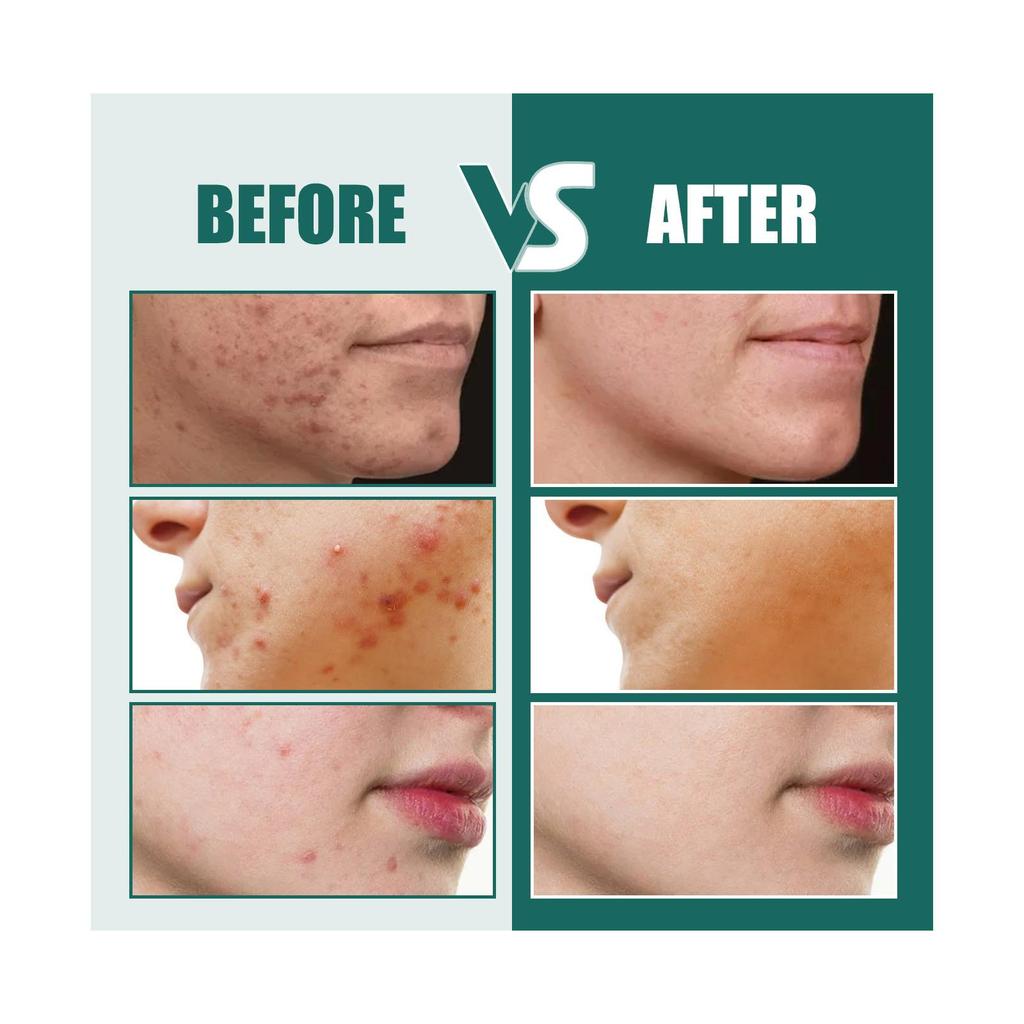 112pcs Invisible Acne Removal Pimple Patch Cute Star Shaped for Face Healing