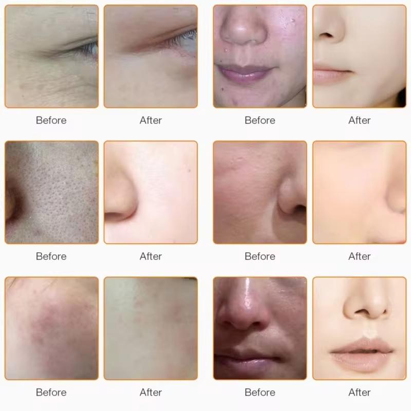 RF Радиочастотный массажер для лица, светодиодный фотонный мезотерапия для лица, электропорация, косметический аппарат, омоложение, лифтинг лица