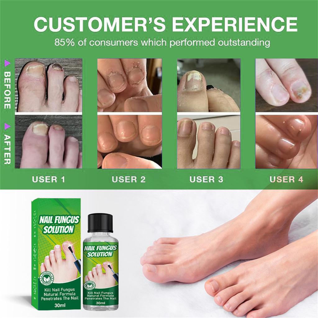 Toenail Fungus Care, FastActing Nail Care Liquid For Fungus Under & Around Restores The Healthy Appearance Of Nails 30ml