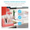 ANNWAN Dental Implant Model 4 Times Removable Analysis Crown Bridge Demonstration Teeth Model for Class Education and Studying Teeth Model