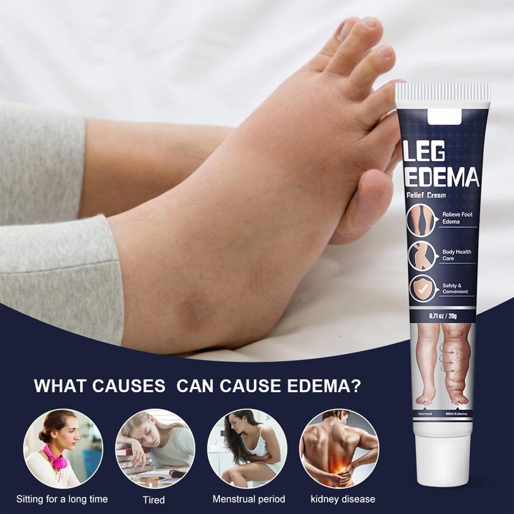 Anti-edema Cream Leg Swelling Edema Cream Arm Calf Foot Massage Health Care Plaster