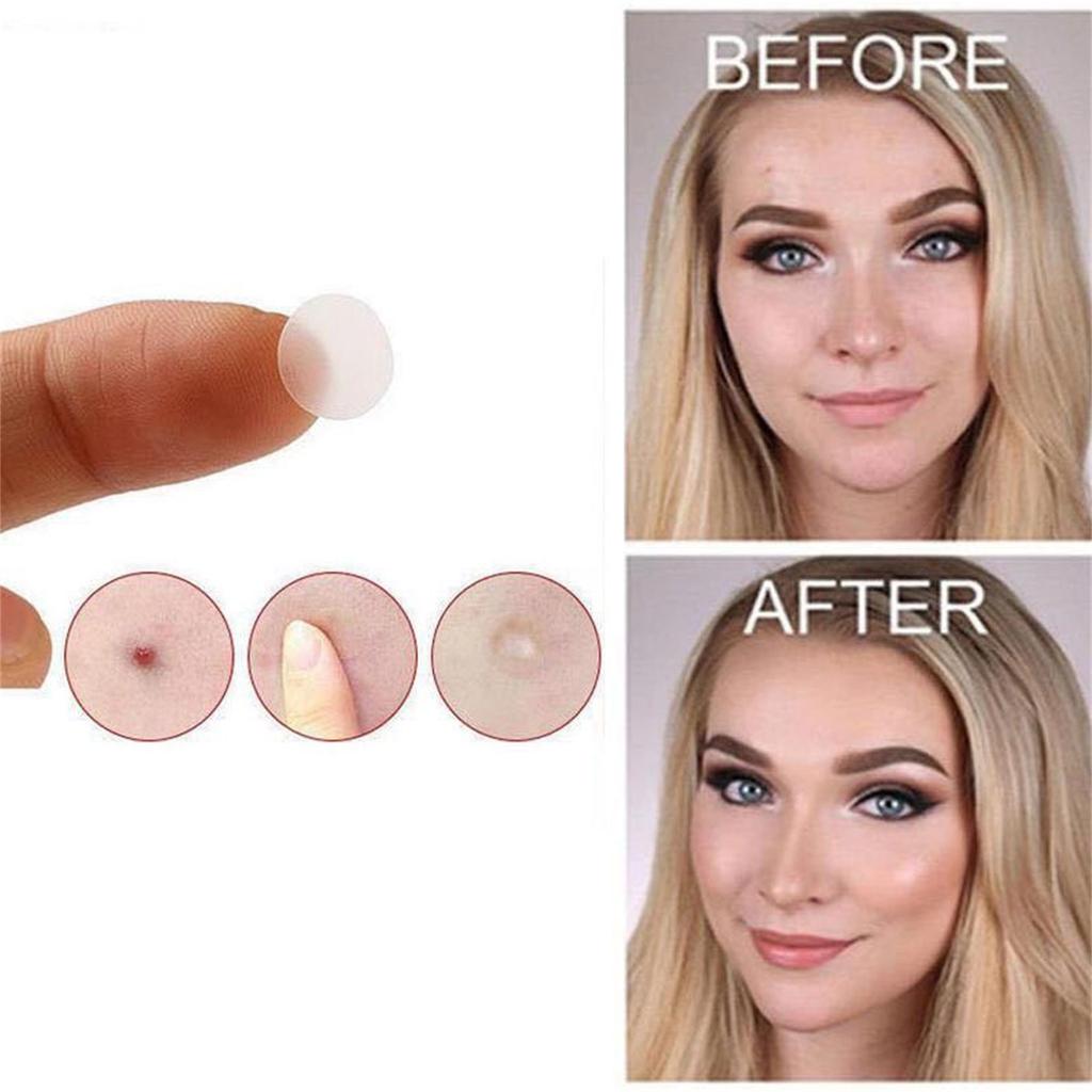 24 шт./36 шт. бирка для удаления кожи, гидроколлоидный пластырь от прыщей, восстановительная подушечка