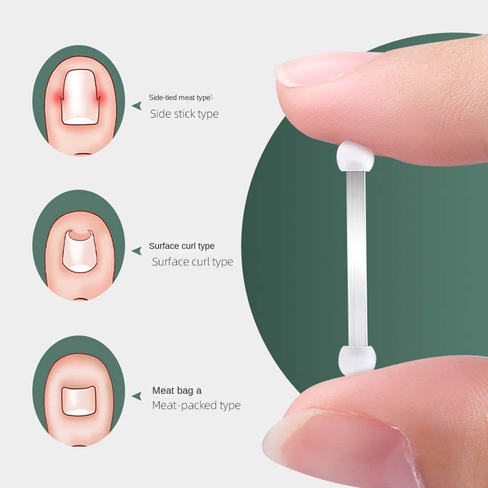 Pedicure Tool Ingrown Toenails Corrector Toenail Fixer Bunion Corrector Toenail Straightener