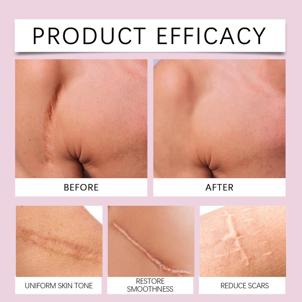 Silicone Scar Cream, Facial Fine Patch Concealer Patch Scar Roll, Reusable (1 Pc)