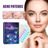 EELHOE 180 Patches Waterproof Acne Pimple Patch Stickers Acne Treatment Pimple Remover Tool Invisible Breathable Acne Patch Skin Care