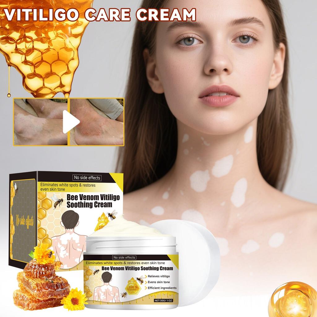 Vitiligo Relief Cream, Skin Care Cream, Vitiligo Cream, Improves Dryness, Suitable For All Skin Types