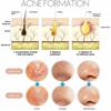 Игла для удаления угрей, набор из 4 предметов, игла для удаления угрей, многофункциональный инструмент для чистки лица, специальное средство для удаления угрей, не повреждает кожу
